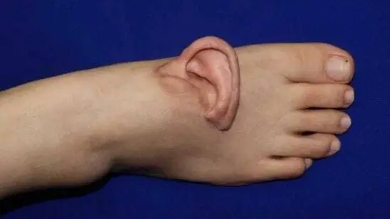 una mujer camina cinco meses con su propia oreja instalada en el empeine